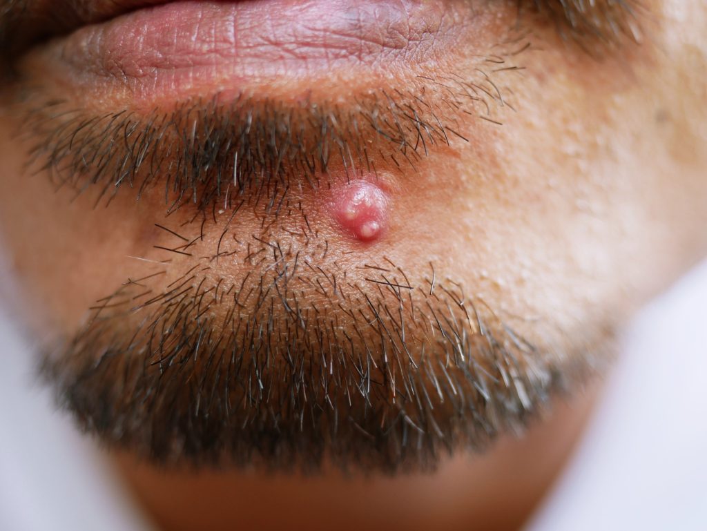 Le furoncle : causes et traitements du bouton