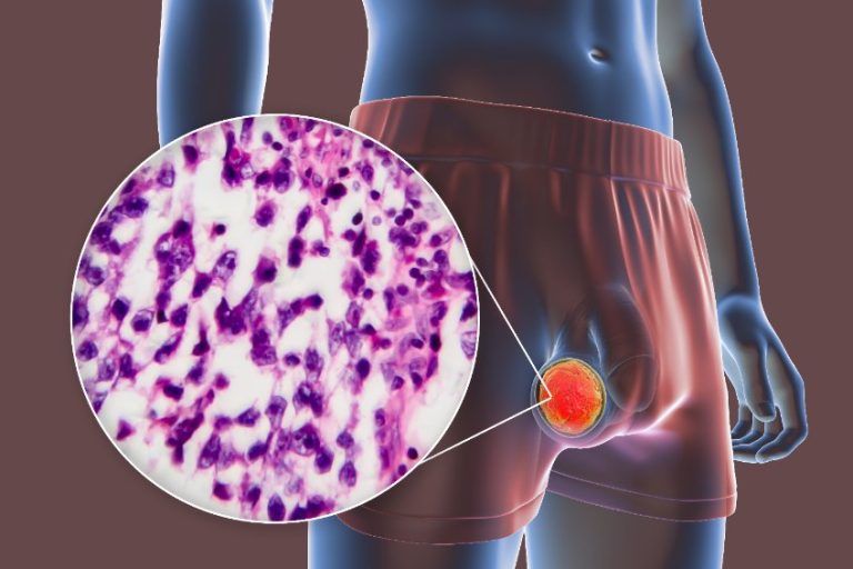 Pathologie des testicules et des bourses : varicocèle, tumeurs testiculaires et paratesticulaires
