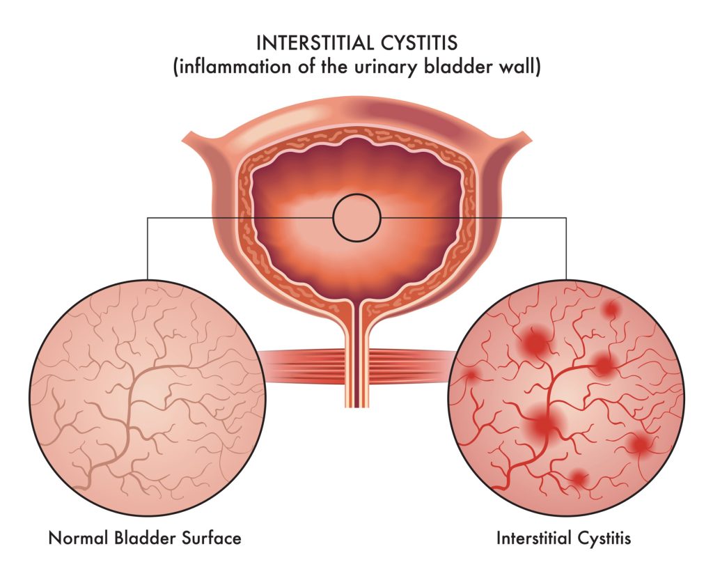 CYSTITE INTERSTITIELLE : causes, symptômes et traitements