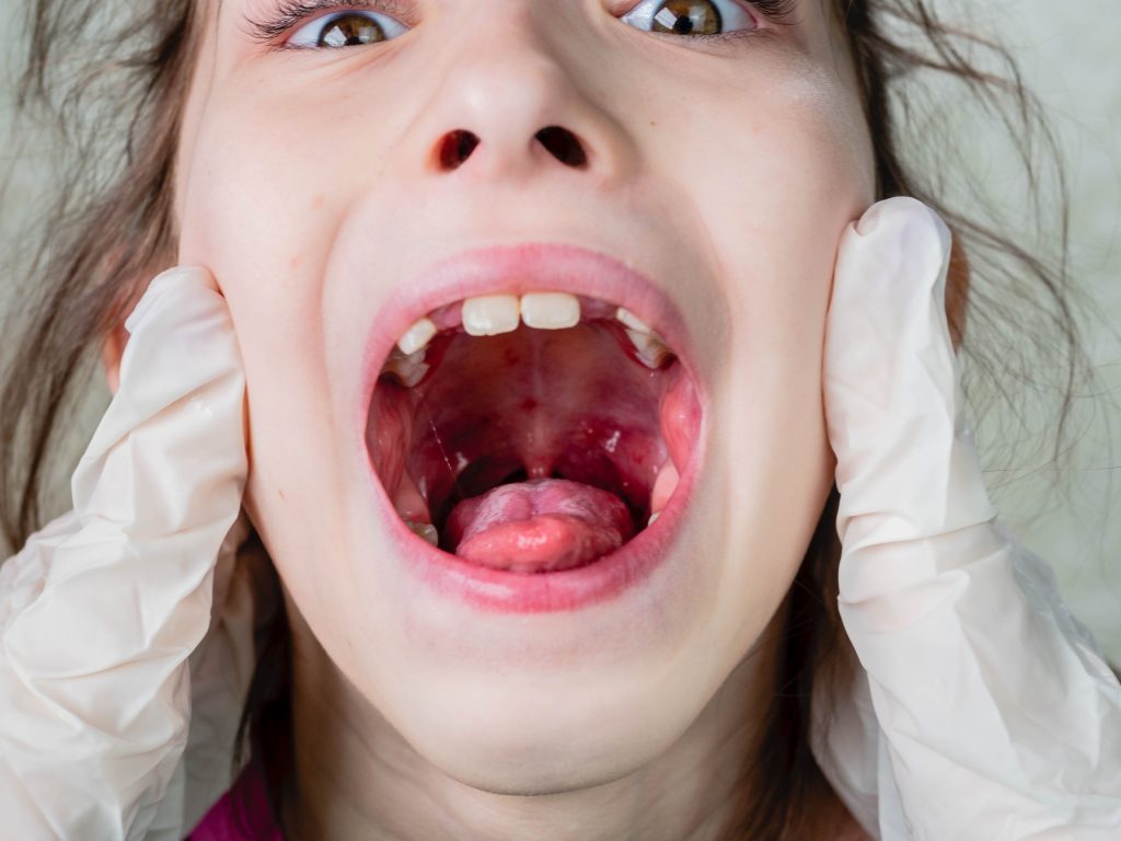 LARYNGITE DE L’ENFANT : causes, symptômes et traitements