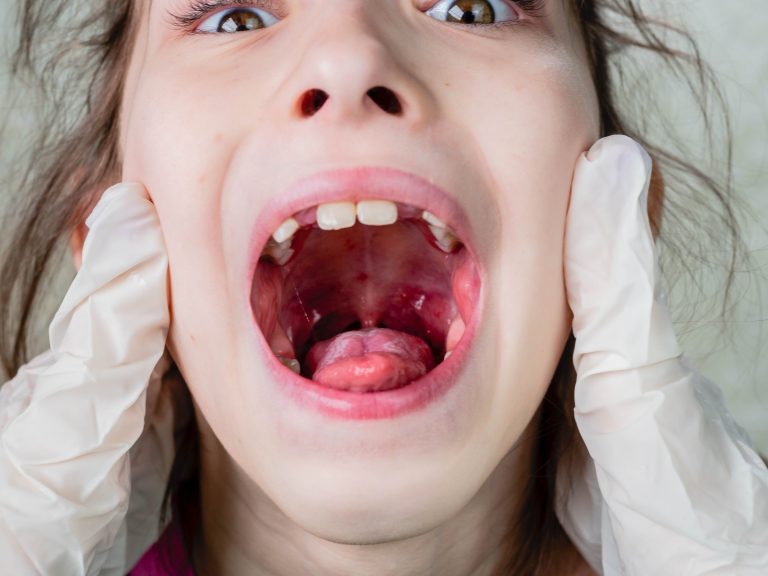 LARYNGITE DE L’ENFANT : causes, symptômes et traitements