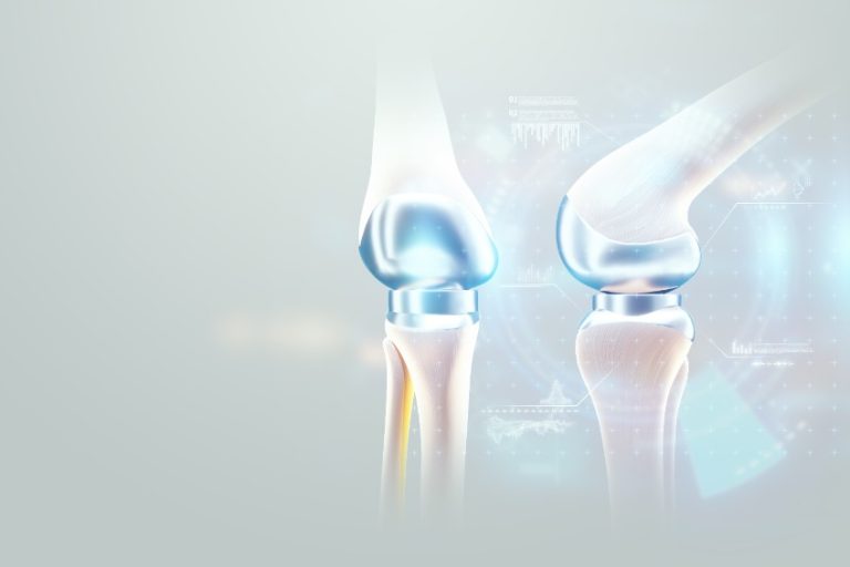 Ostéoporose : Classification, Causes, Symptômes, Traitement