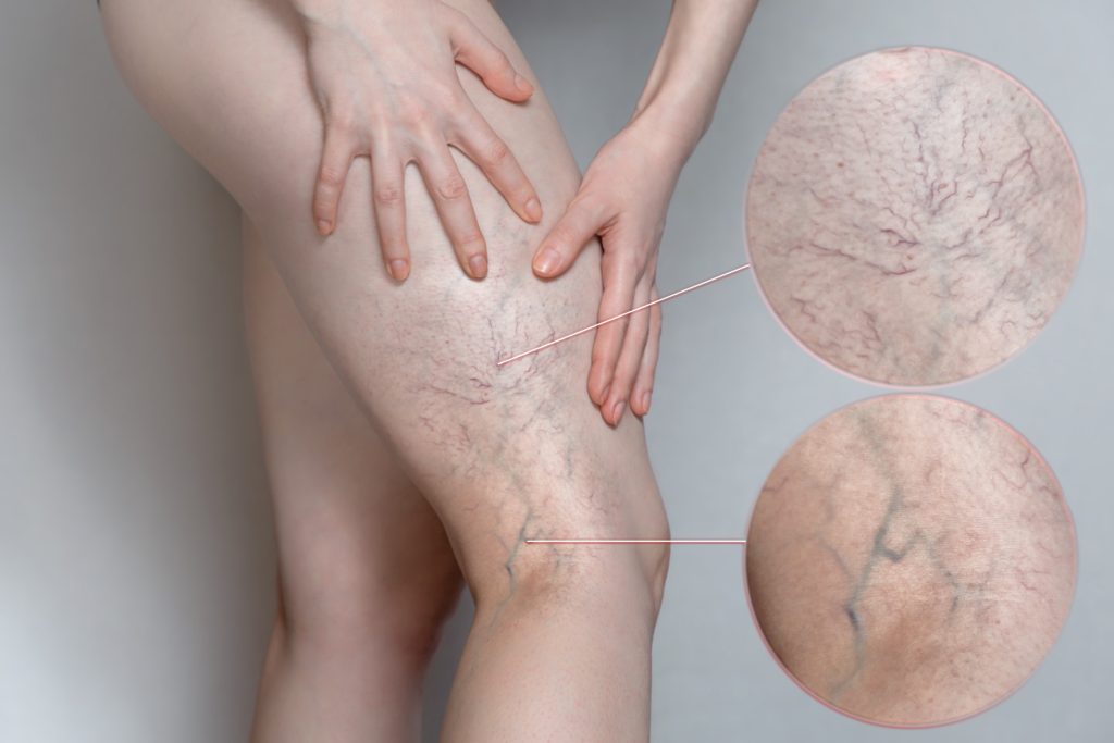 Thrombophlébites superficielles du membre inférieur