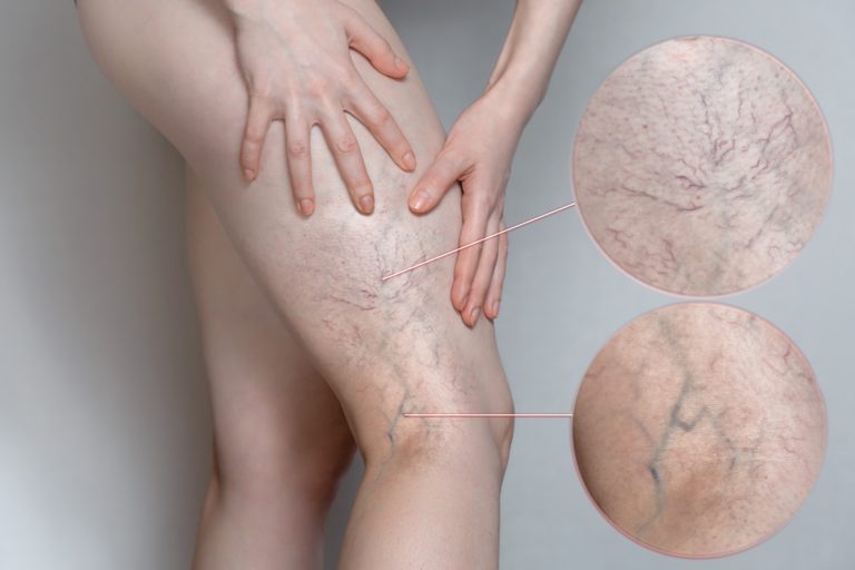 Thrombophlébites superficielles du membre inférieur