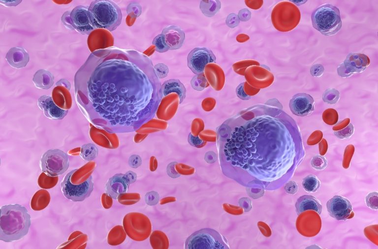 Maladie de Waldenström : Causes, symptômes, diagnostic et traitement