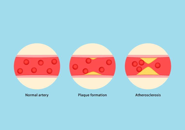 Comment déterminer le RISQUE VITAL CARDIOVASCULAIRE