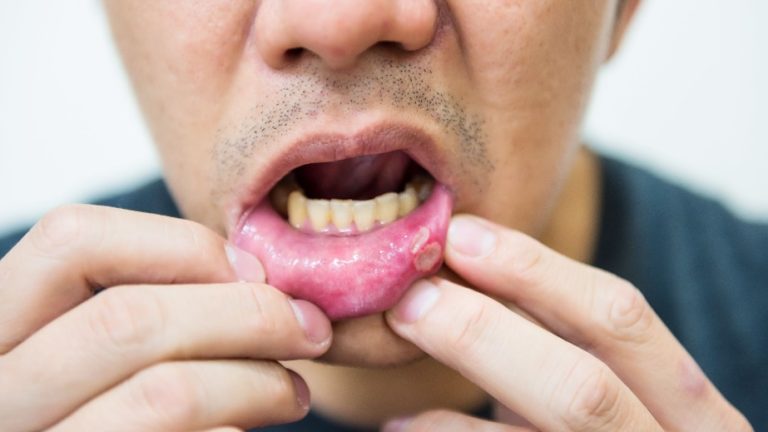 La maladie de Behçet : Causes,Signes, Diagnostic, Traitement