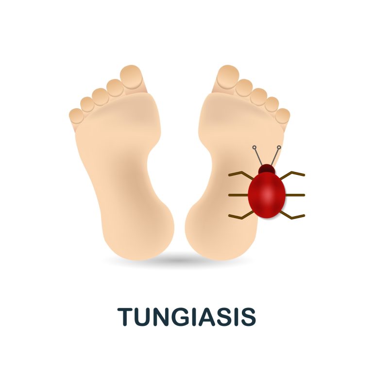 Tungose ou puce-chique: causes et traitements
