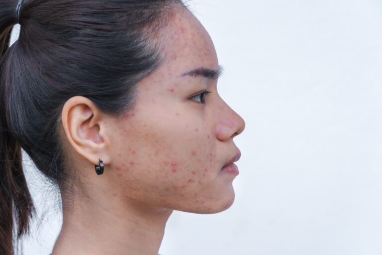 Acné hormonale chez une jeune femme