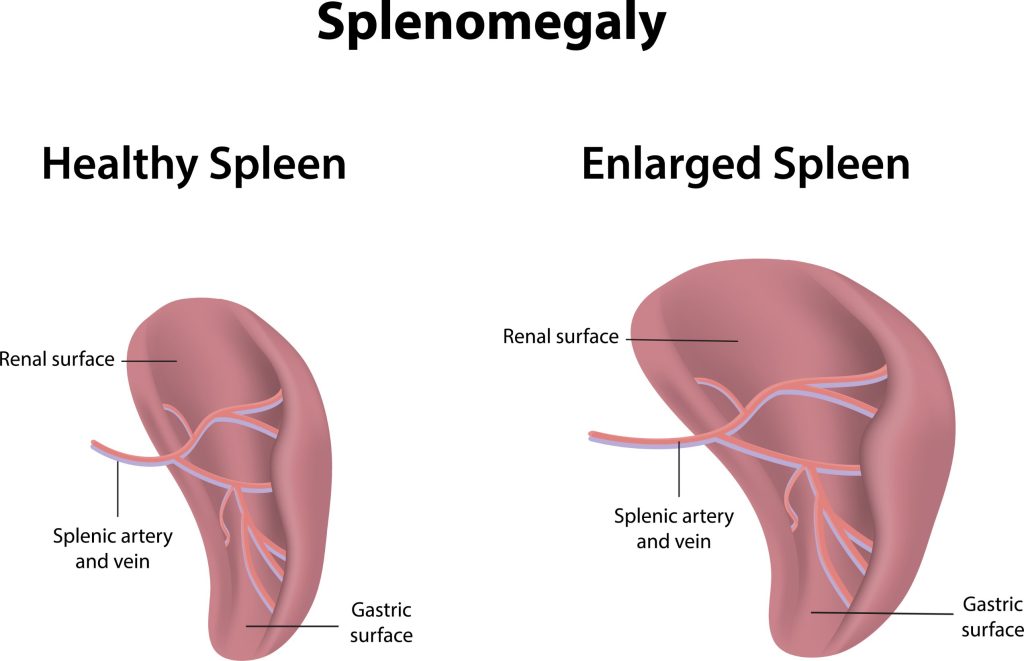 Splénomégalie: Causes, Symptômes et Traitements
