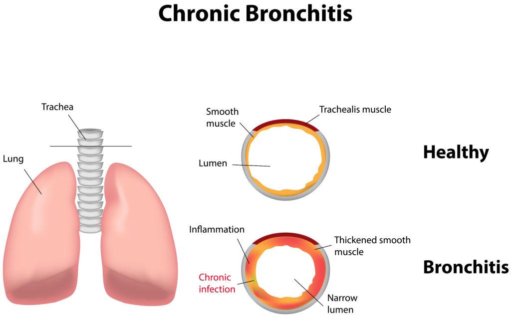 Comment soigner une bronchite chronique ?