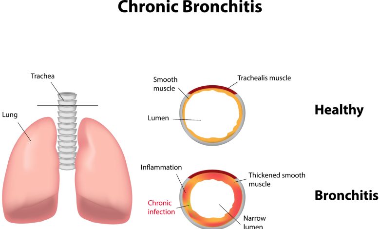 Comment soigner une bronchite chronique ? - esculape