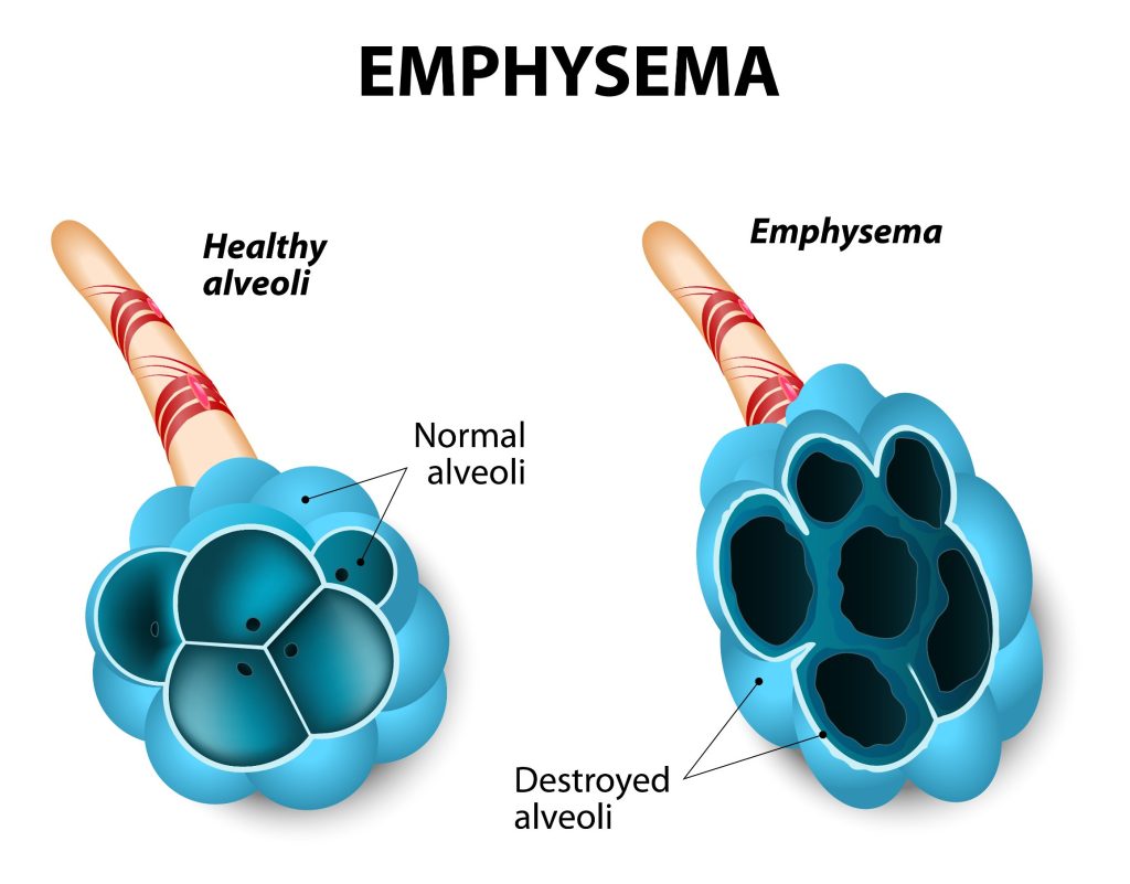 Emphysème pulmonaire : causes, symptômes et traitements