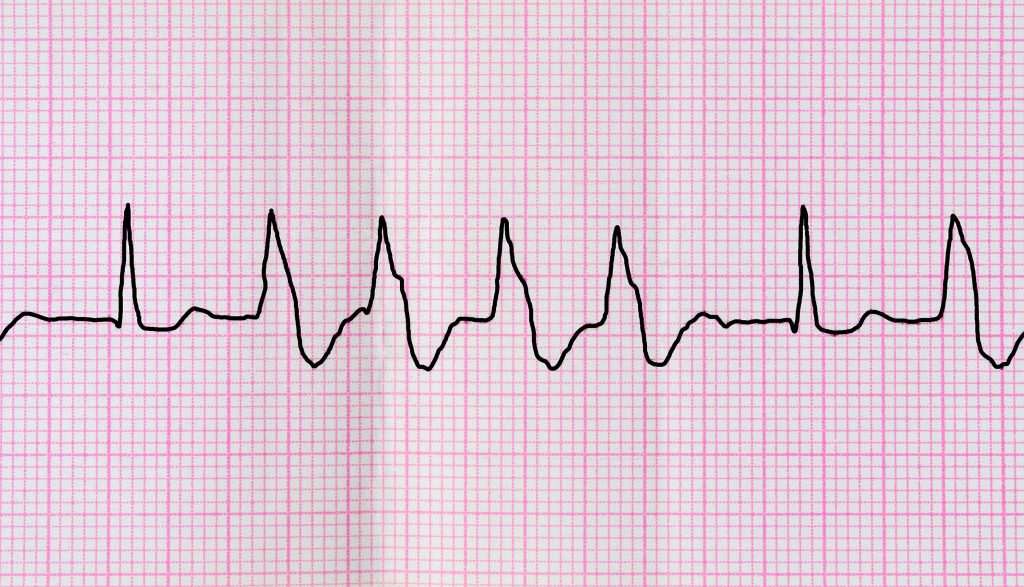 Extrasystoles ventriculaires : causes, facteurs de risque et traitements