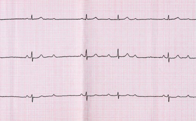 Bloc auriculo-ventriculaire (BAV) : causes, symptômes, diagnostic, traitement