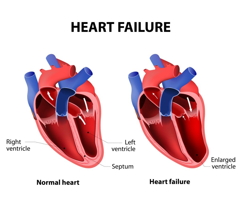 Insuffisance cardiaque droite: causes, symptômes et traitements