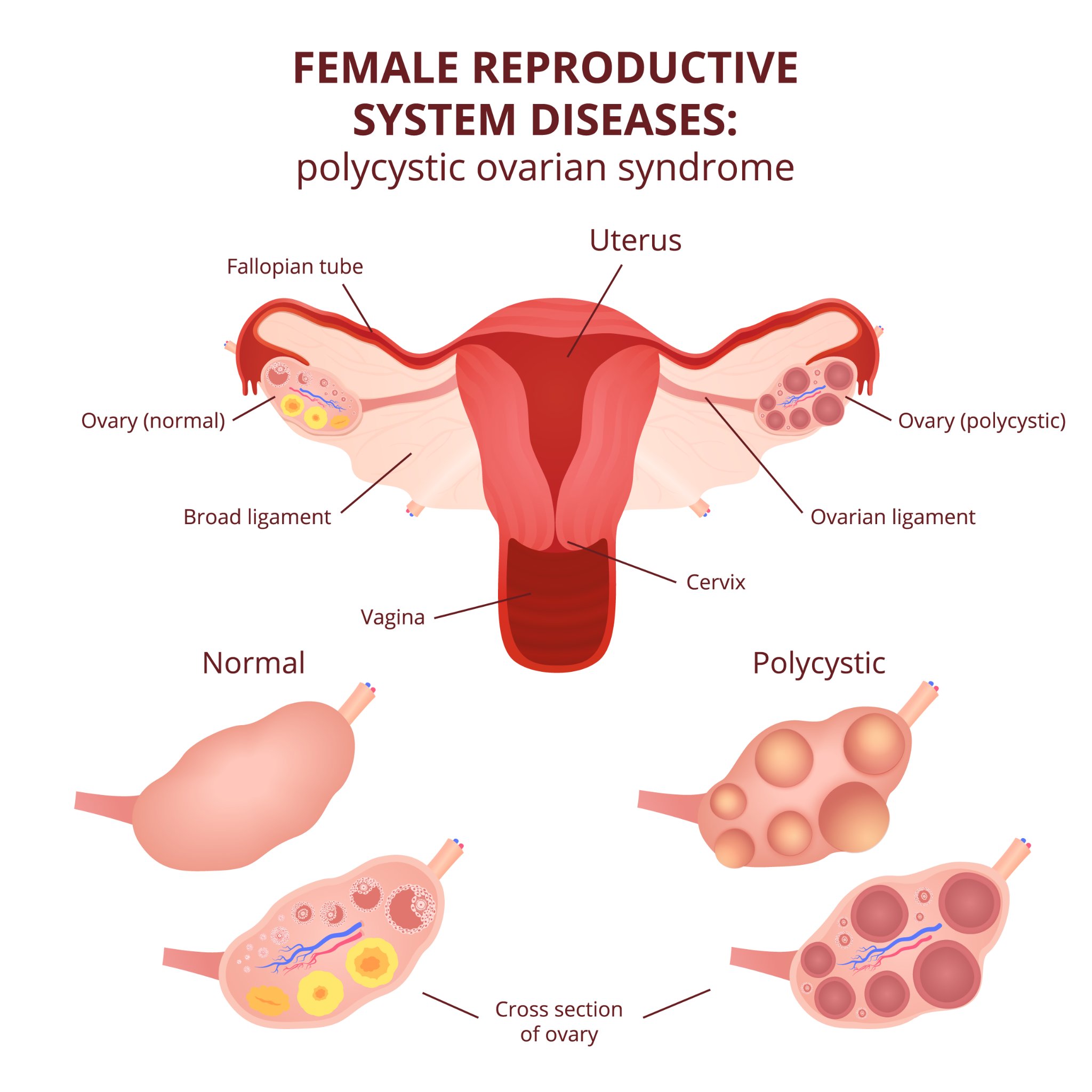 Dystrophie ovarienne : causes, symptômes et traitements - esculape