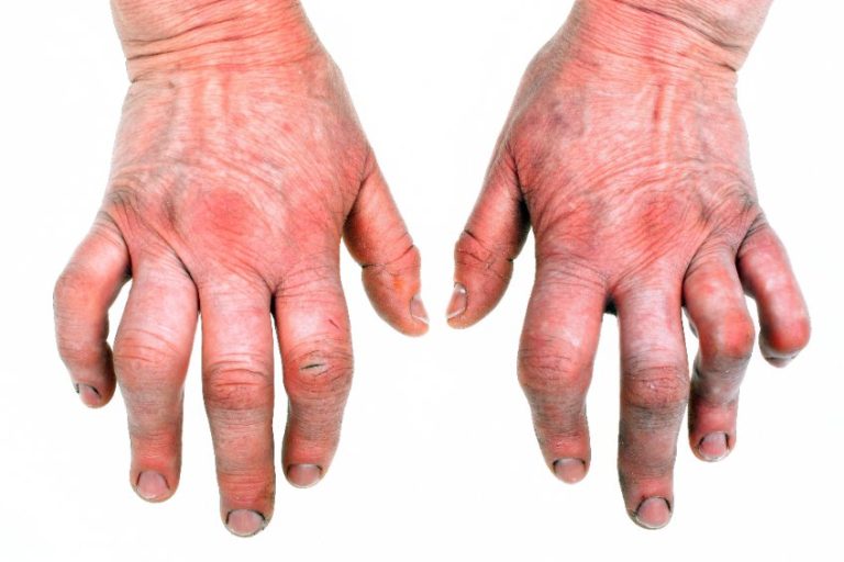 Les marqueurs de la polyarthrite rhumatoïde : présentation et liste