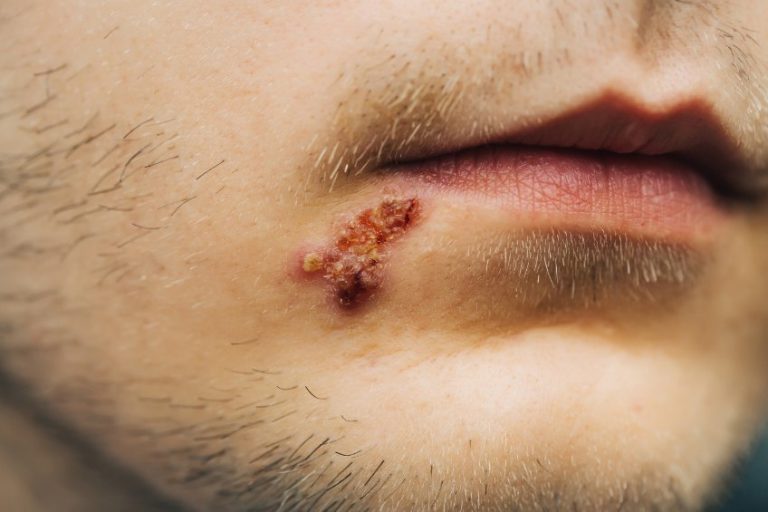 Aphtes et aphtoses : formes, causes, symptômes, traitement