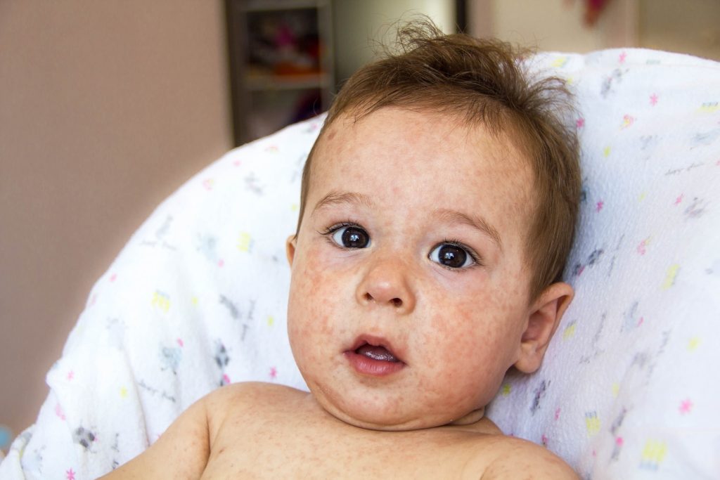 Dermatite atopique du nourrisson : causes, symptômes et traitements
