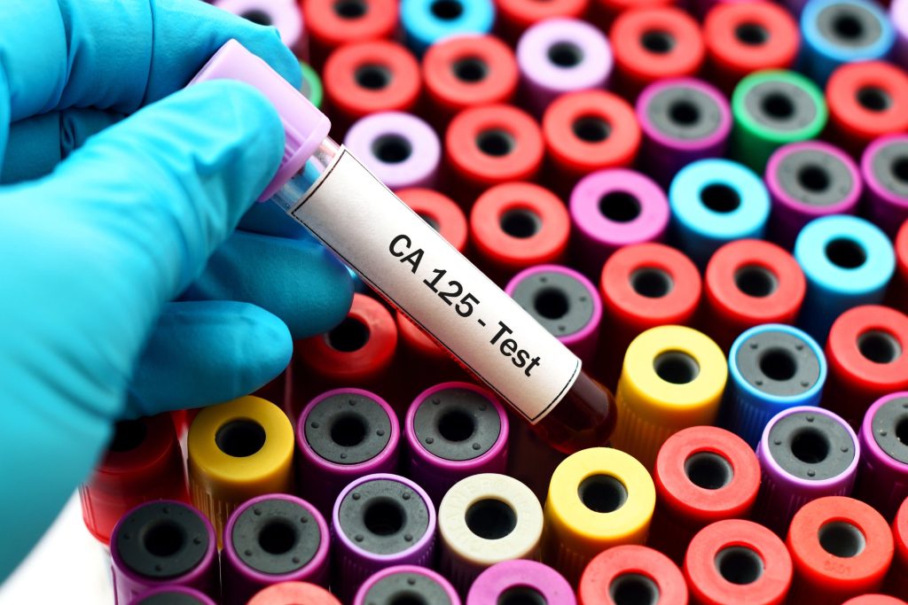 CA 125 et Détection du cancer de l’ovaire