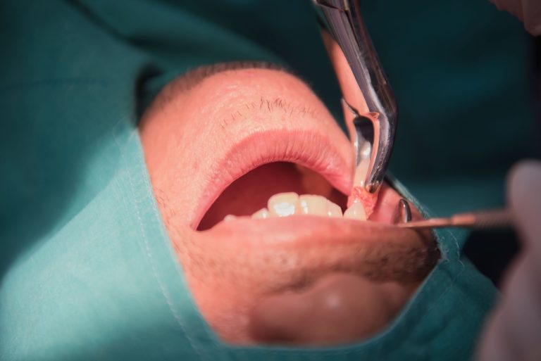 Extraction dentaire sous antiagrégants plaquettaires ou avk: risques et précautions
