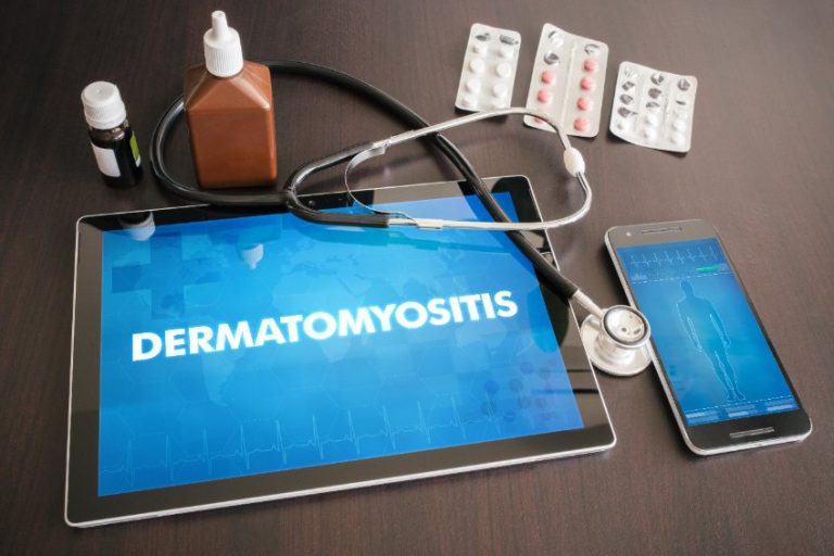 Dermatomyosites : clinique, diagnostic, étiologies, traitement