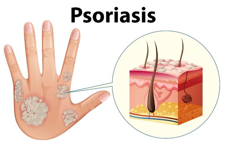 Lésions oculaires du psoriasis : typologie