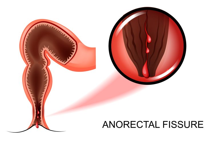 FISSURE ANALE: comment traiter la déchirure de l&rsquo;anus?