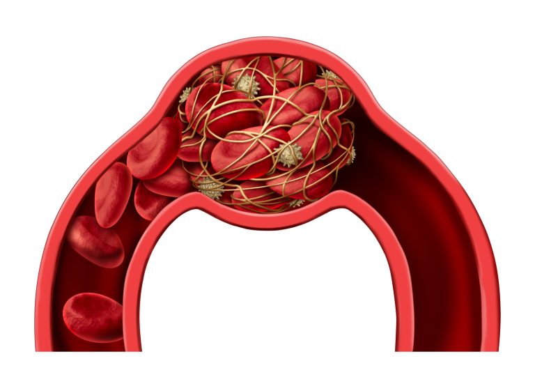 Thrombose veineuse profonde (TVP) et antivitamine K (AVK) :que savoir ?