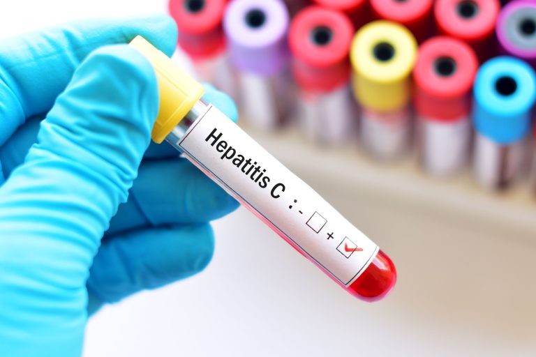 Hépatite C : causes, symptômes et traitements
