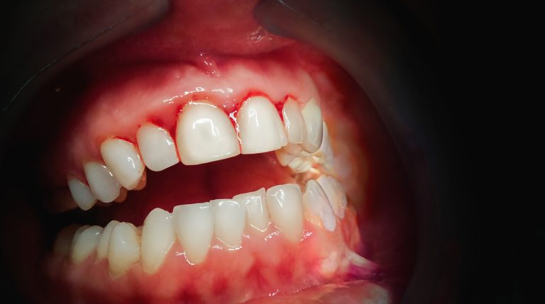 Comment traiter une inflammation de la gencive ?