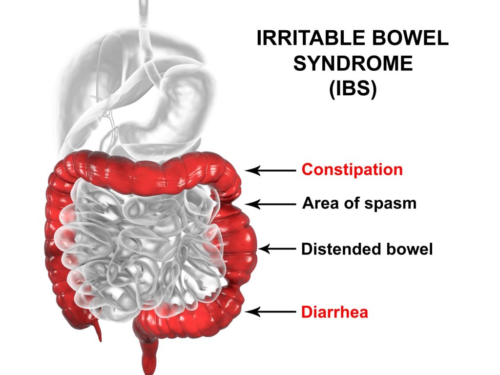 Côlon irritable : causes, symptômes et traitements