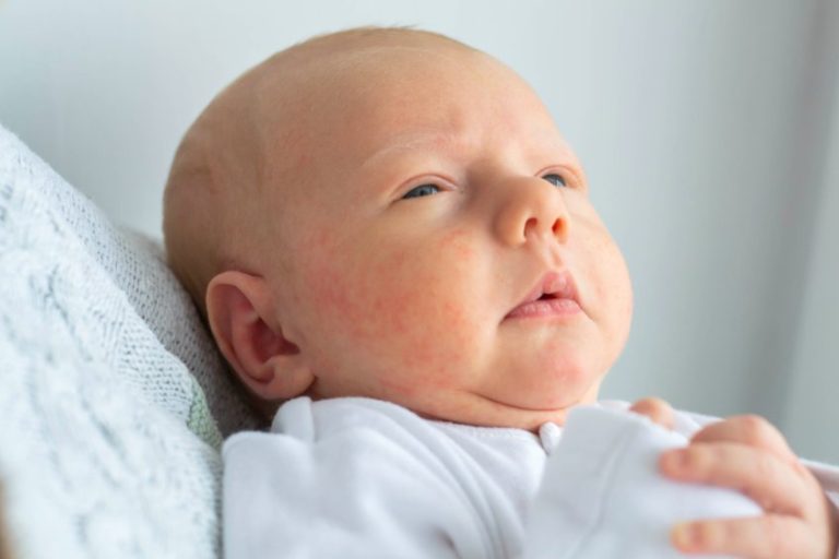 Exanthème Périflexural Asymétrique de l’enfance : Symptômes, causes, traitements