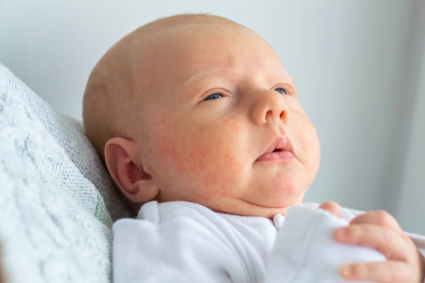 Exanthème Périflexural Asymétrique de l’enfance : Symptômes, causes, traitements 97900184 S