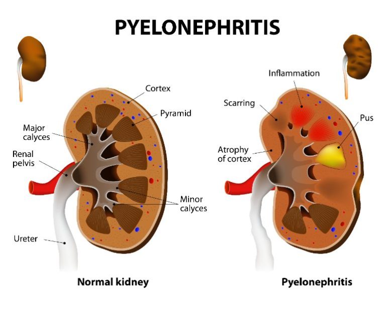 Pyélonéphrite et grossesse : causes, symptômes, traitement