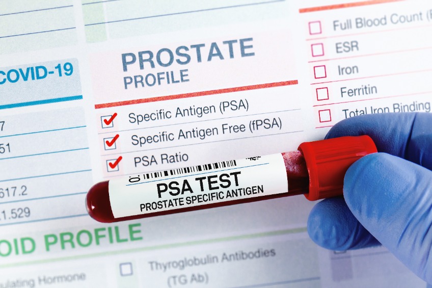 Antigène spécifique de la prostate (PSA) : Des concepts sur l ...