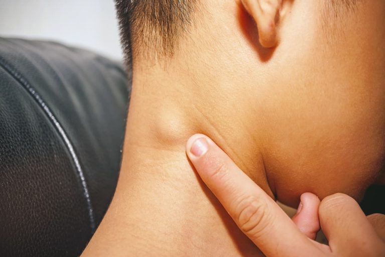 Adénopathie : types, causes et traitements