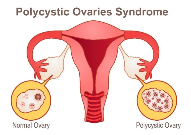 La contraception des dystrophies ovariennes : indications et contre-indications