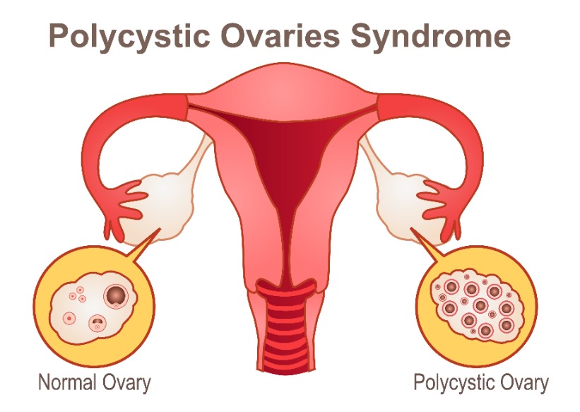 La contraception des dystrophies ovariennes : indications et ...
