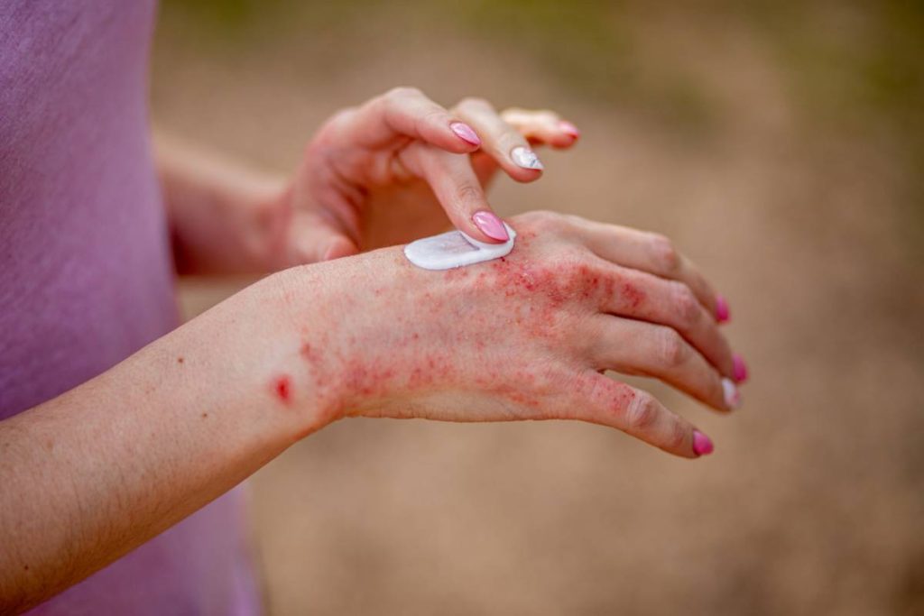 Eczema Psoriasis Les Maladies De Peau Sont Elles Hereditaires 1024x683