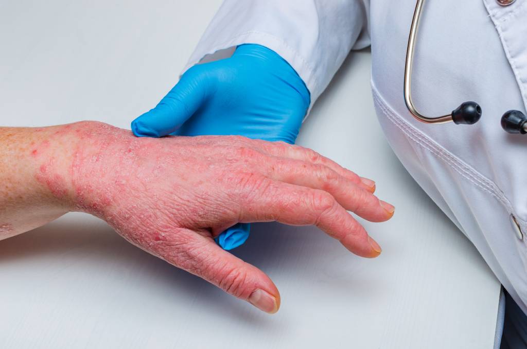 crises soulager sympt&ocirc;mes stress alimentation cr&egrave;mes soins naturels lotion rougeurs d&eacute;mangeaisons