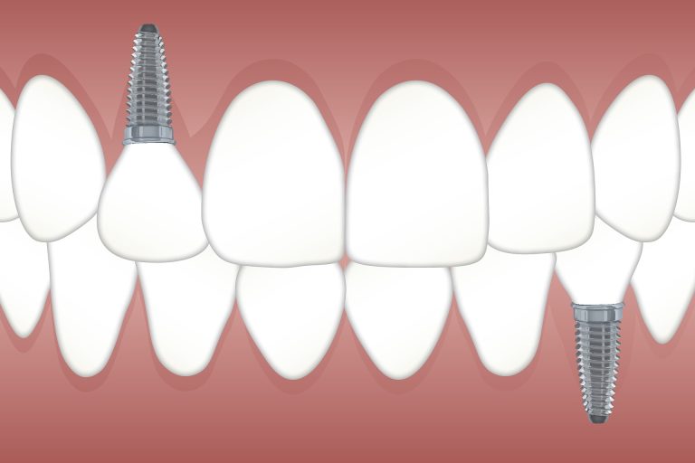 L’implant dentaire, une pratique tendance ces dernières années