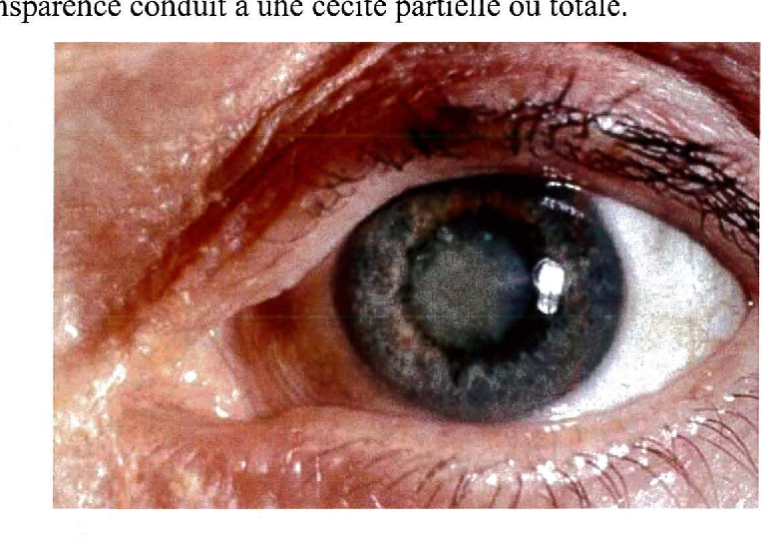 La toxoplasmose oculaire : symptômes et traitements