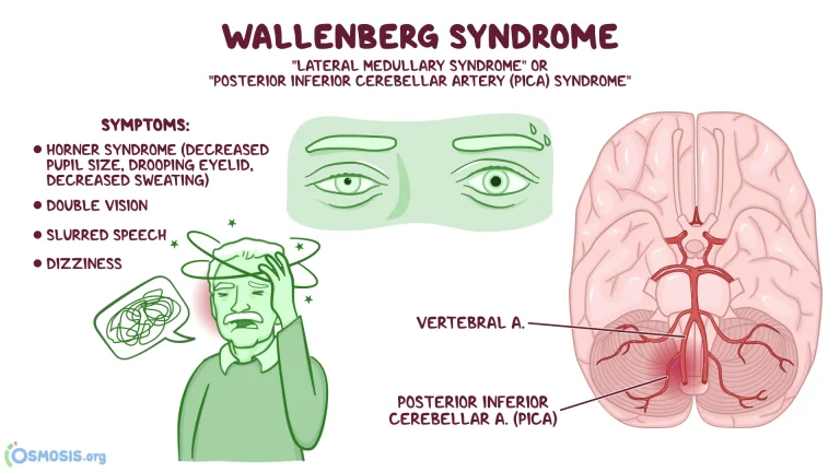 Comment traiter le syndrome de Wallenberg ?