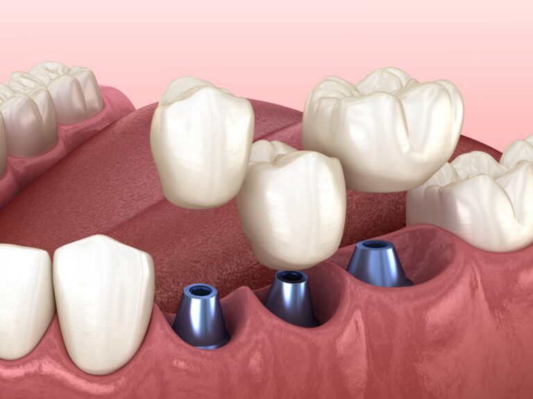 Concept de pose d’implants dentaires
