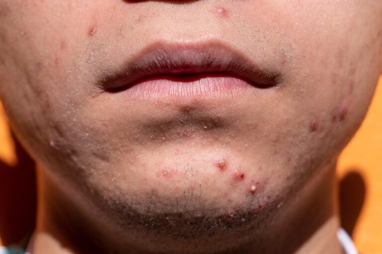 Le traitement de l’acné au laser AviClear : une révolution dermatologique