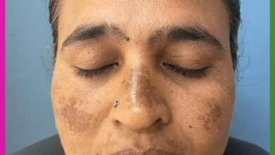 melasma
