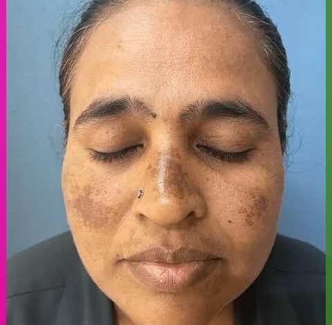 melasma