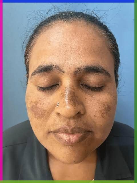 melasma
